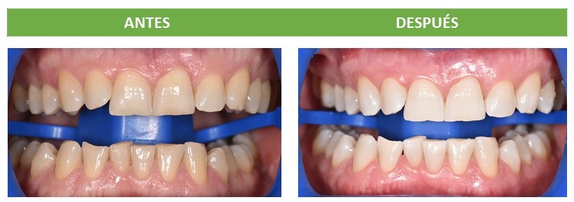 Blanqueamiento. Antes y Después.jpg